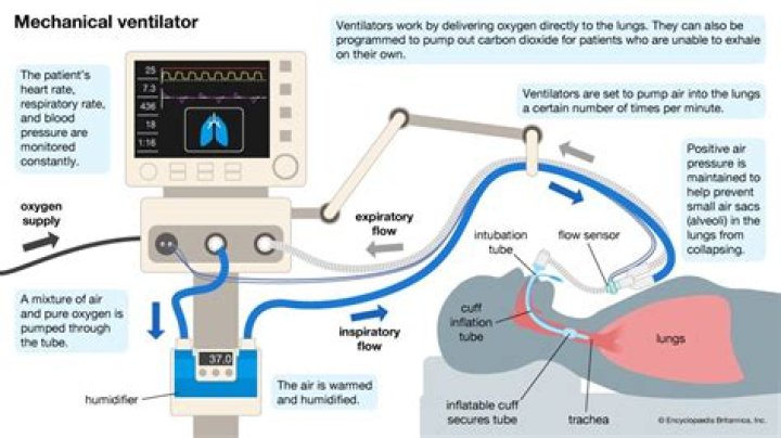 Are ventilators necessary for Covid?