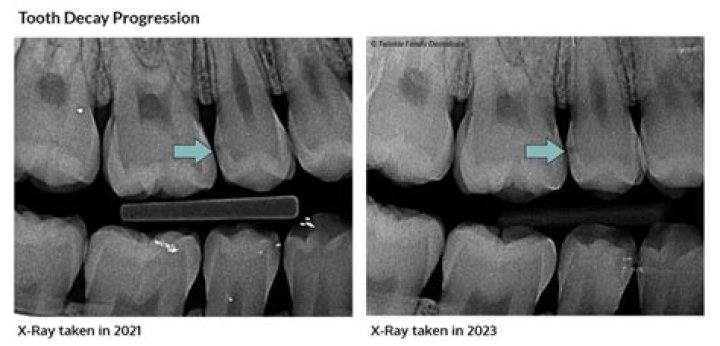 At what point is it too late to save a tooth?