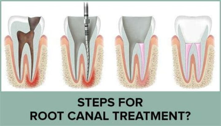 Can a dentist remove a root canal tooth?