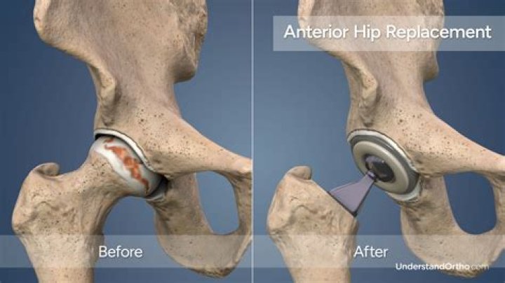 Can a person run or jog after a hip replacement?