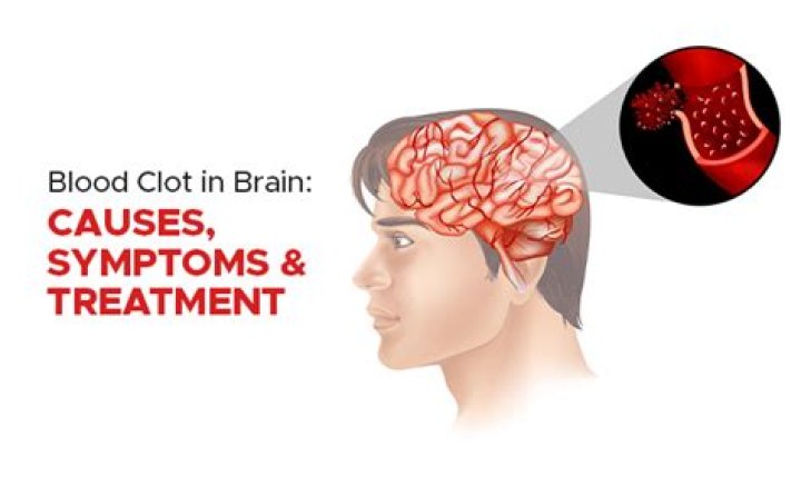 Can brain clot be cured?