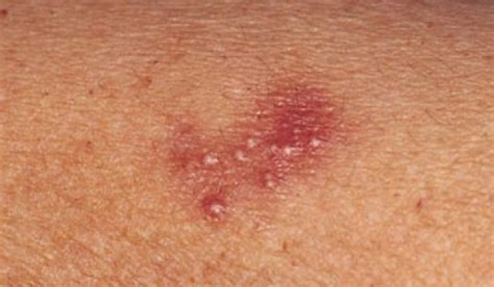 Can chlamydia cause bumps?