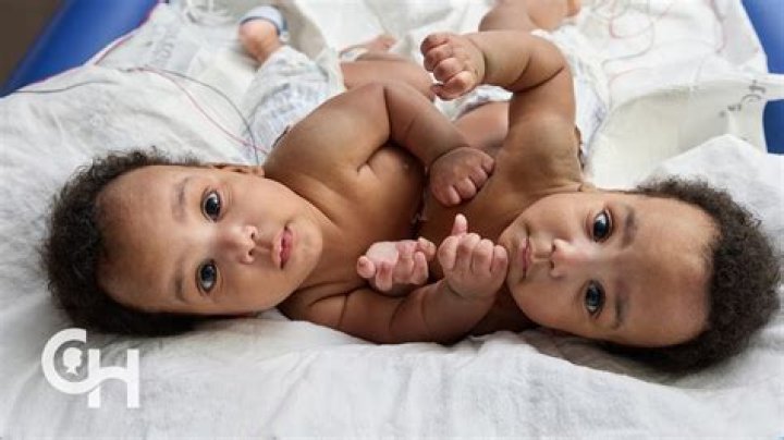 Can conjoined twins be male?