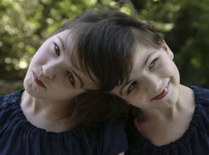 Can conjoined twins hear each other's thoughts?