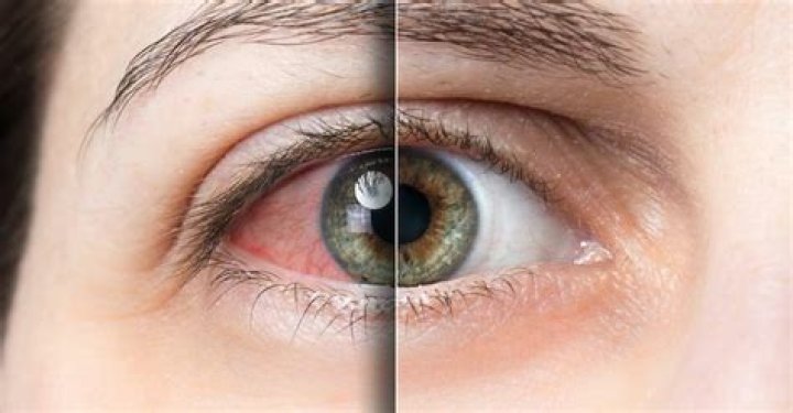 Can dry eyes be cured?