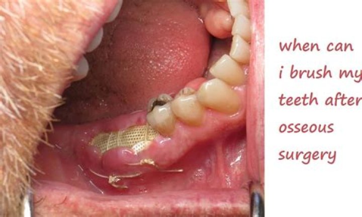 Can I brush my teeth the day of surgery?