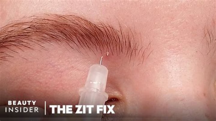 Can I poke a cystic pimple with a needle?