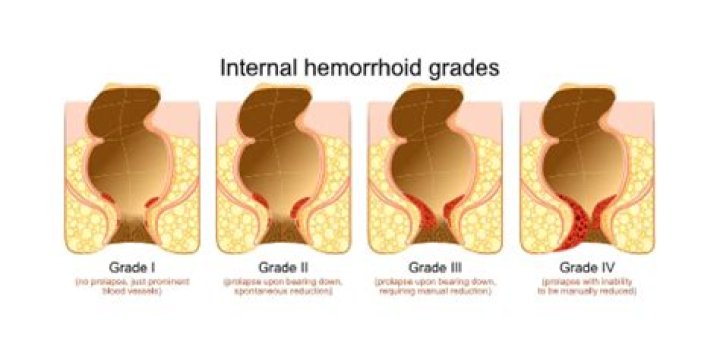 Can ice make a hemorrhoid worse?
