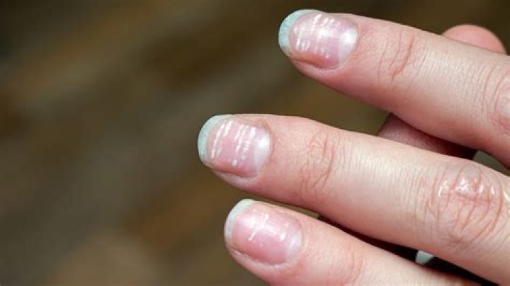 Can iron deficiency cause white spots on nails?