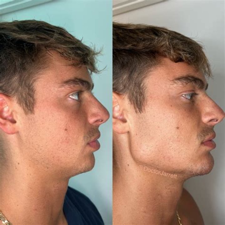 Can jawline be improved?