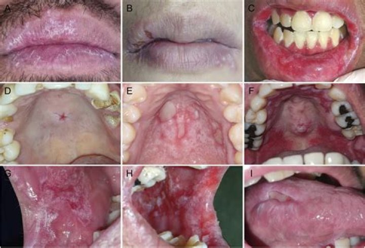 Can lupus skip a generation?