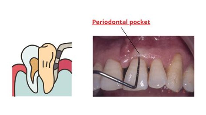 Can periodontal pockets heal?