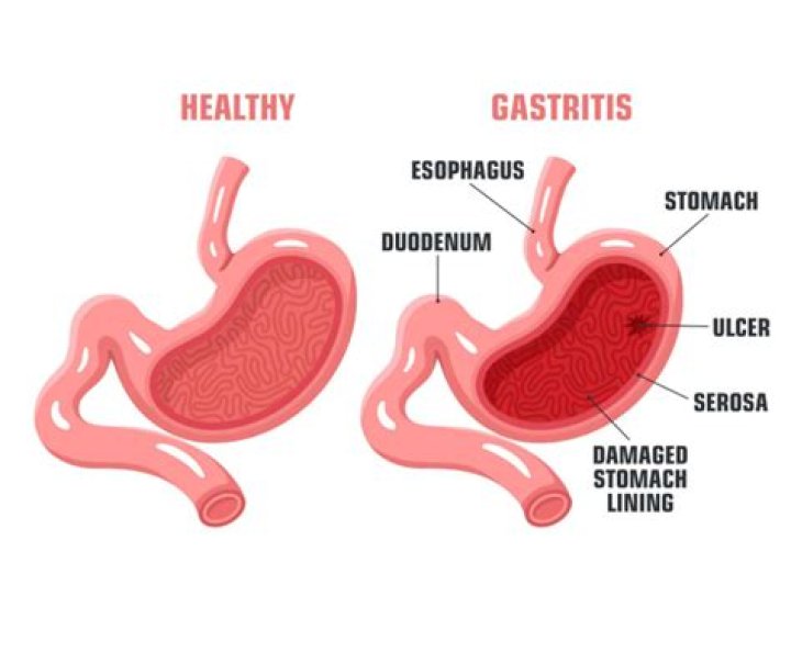 Can turmeric heal gastritis?