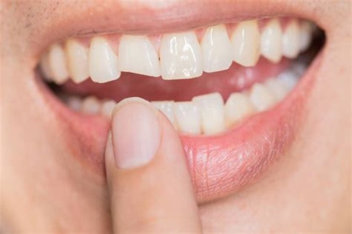 Can veneers break?