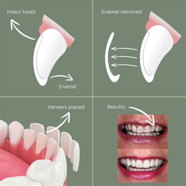 Can veneers slide down?