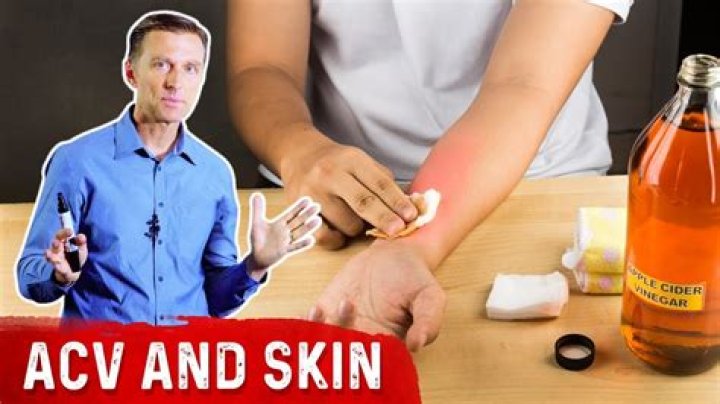 Can vinegar burn your skin?