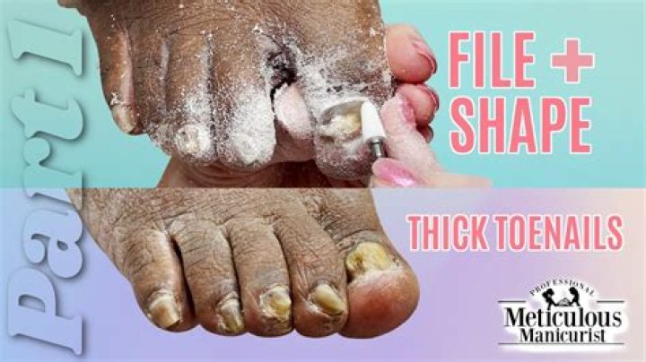 Can you file thick toenails down?
