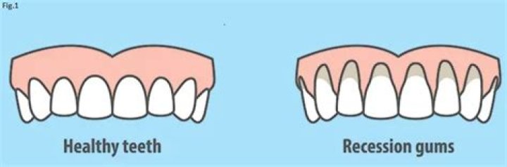 Can you fix gum recession?