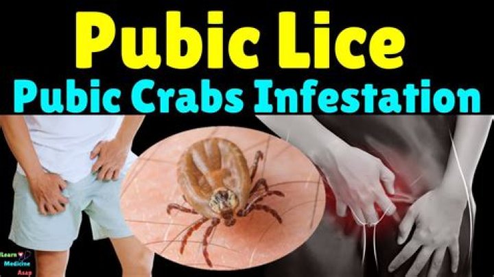 Can you get lice in your private area?