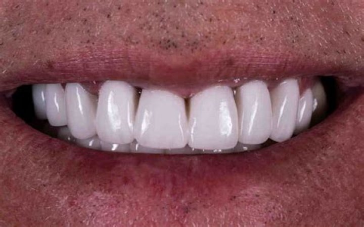 Can you live without a molar tooth?