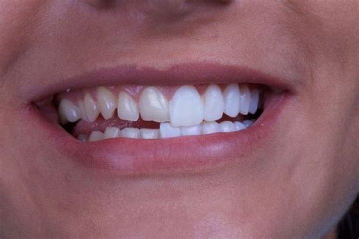 Can you remove veneers?