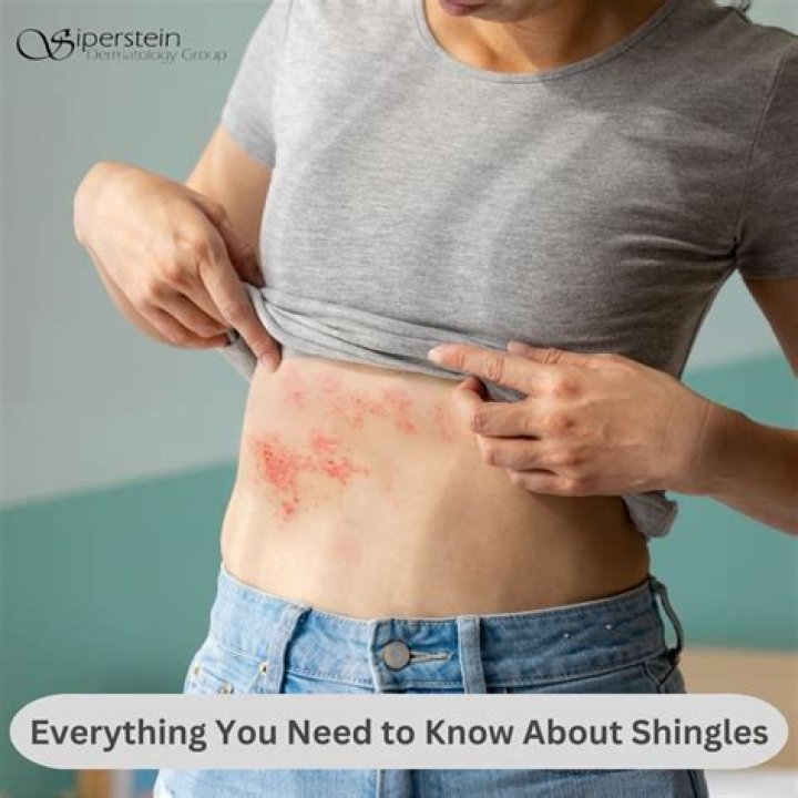 Can you spread shingles by scratching?