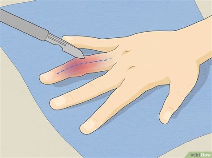 Can your finger fall off?