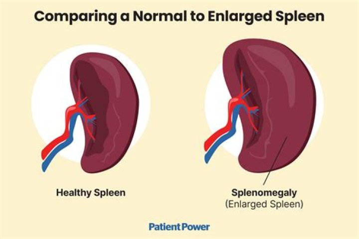 Can your spleen hurt after eating?