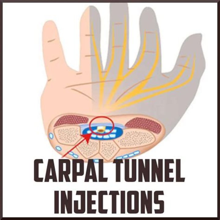 Do cortisone shots help carpal tunnel?