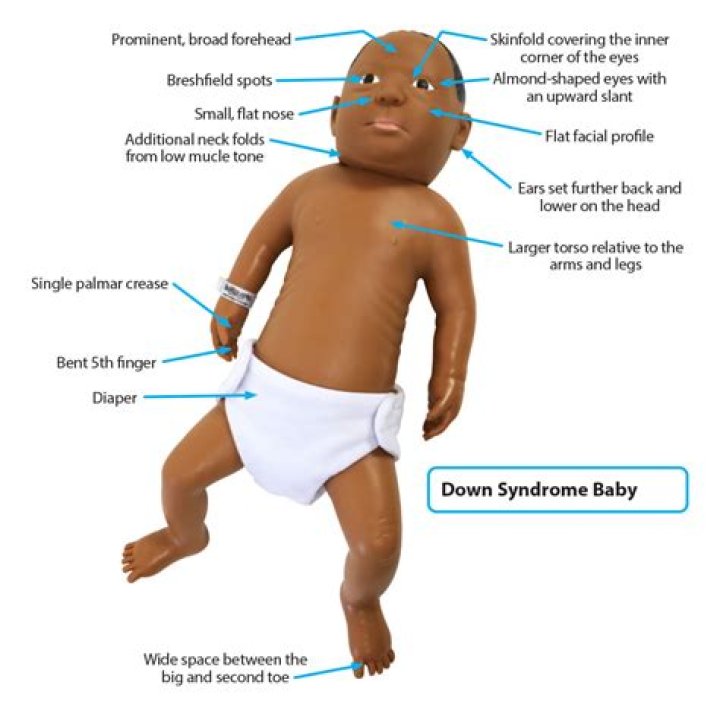 Do Down syndrome babies have fast heartbeats?