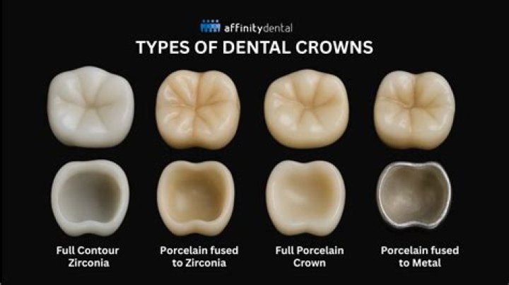 Do permanent crowns fall out?