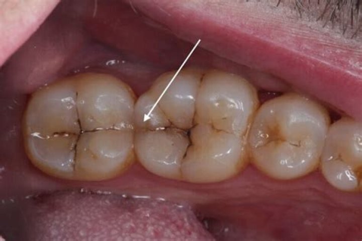 Do veneers go on molars?