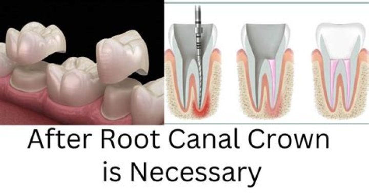 Do you always need a root canal before a crown?