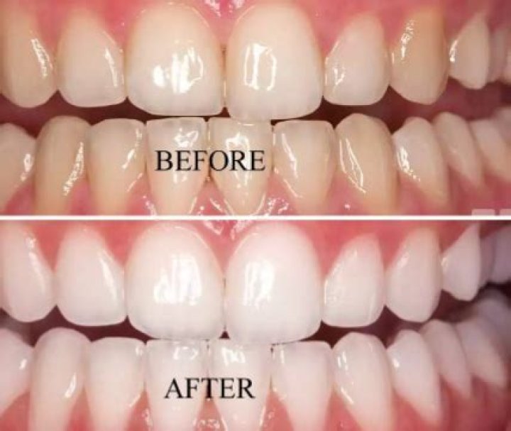 Does baking soda and coconut oil whiten teeth?