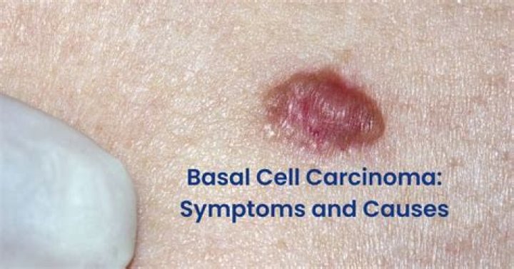 Does basal cell carcinoma look like a pimple?