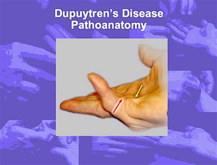 Does Dupuytren's show up on xray?