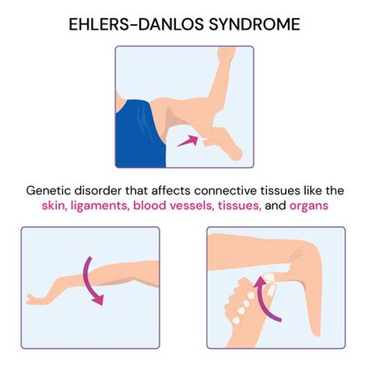 Does Ehlers-Danlos get worse with age?