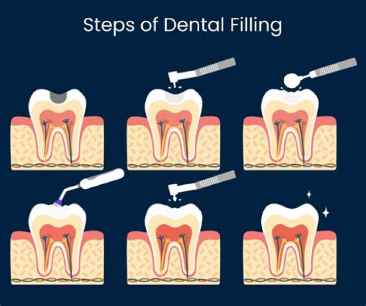 Does filling a cavity hurt?