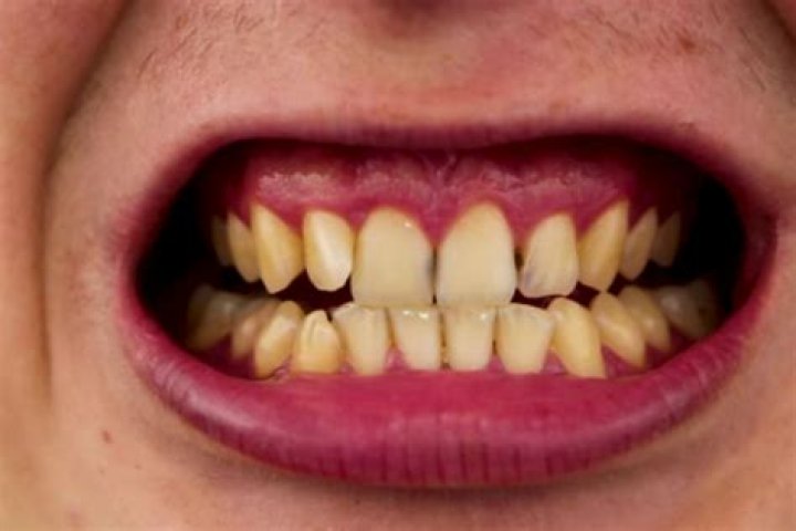 Does hard water cause yellow teeth?