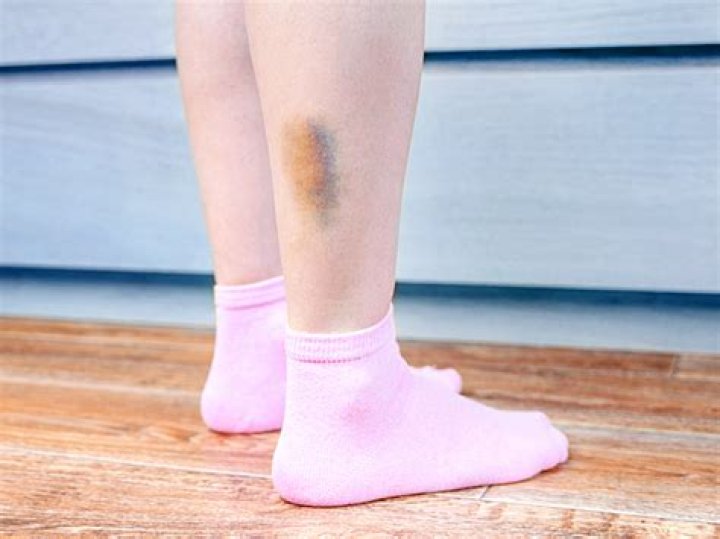 Does internal bleeding heal itself?