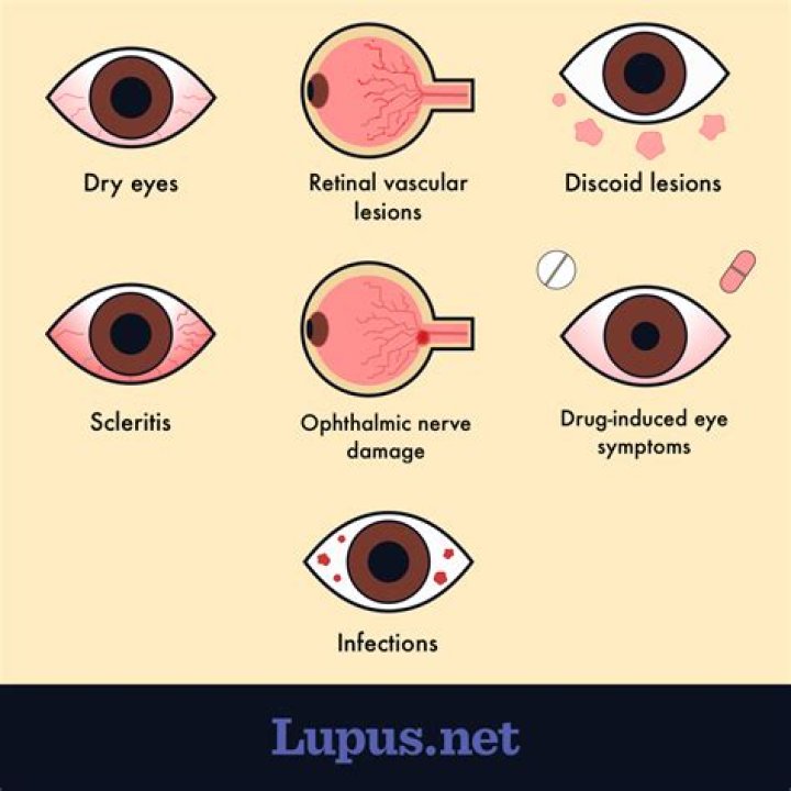Does lupus affect your eyes?