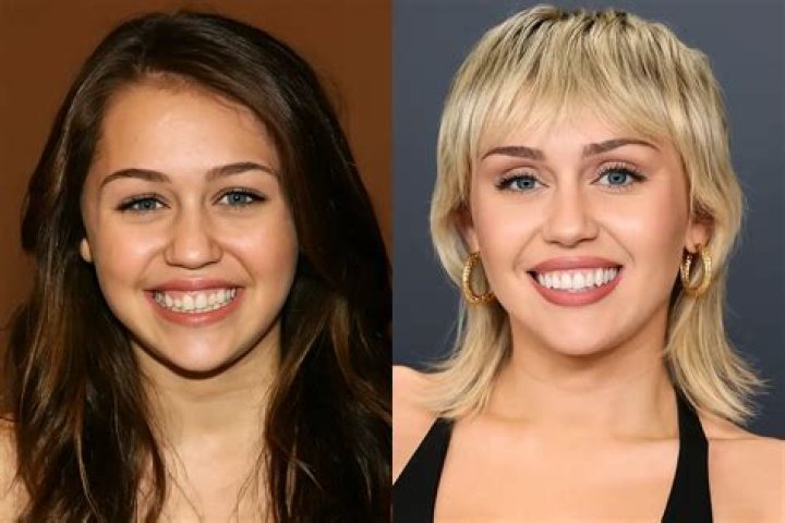 Does Miley Cyrus have veneers?