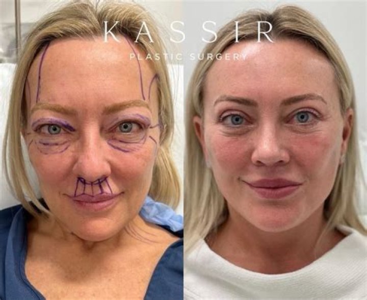 Does plastic surgery hurt?