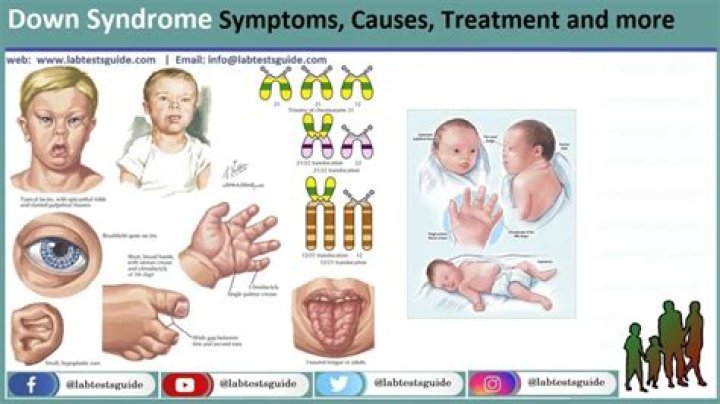 Does the mother or father cause Down syndrome?