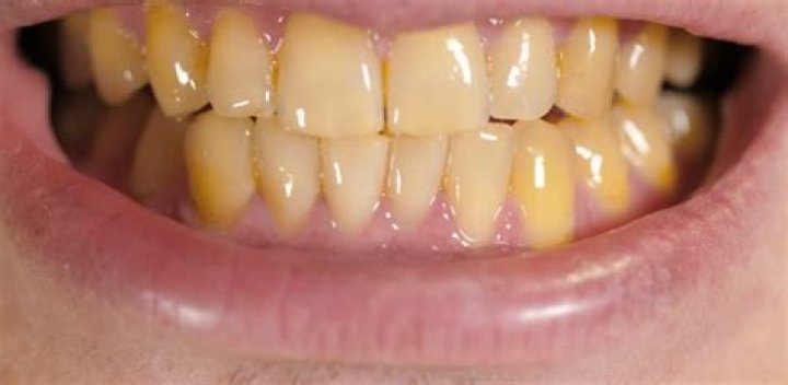 Does turmeric make teeth yellow?