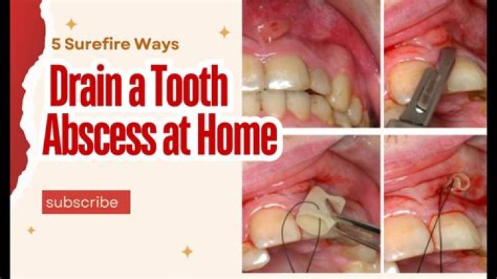 How can I drain an abscessed tooth at home?