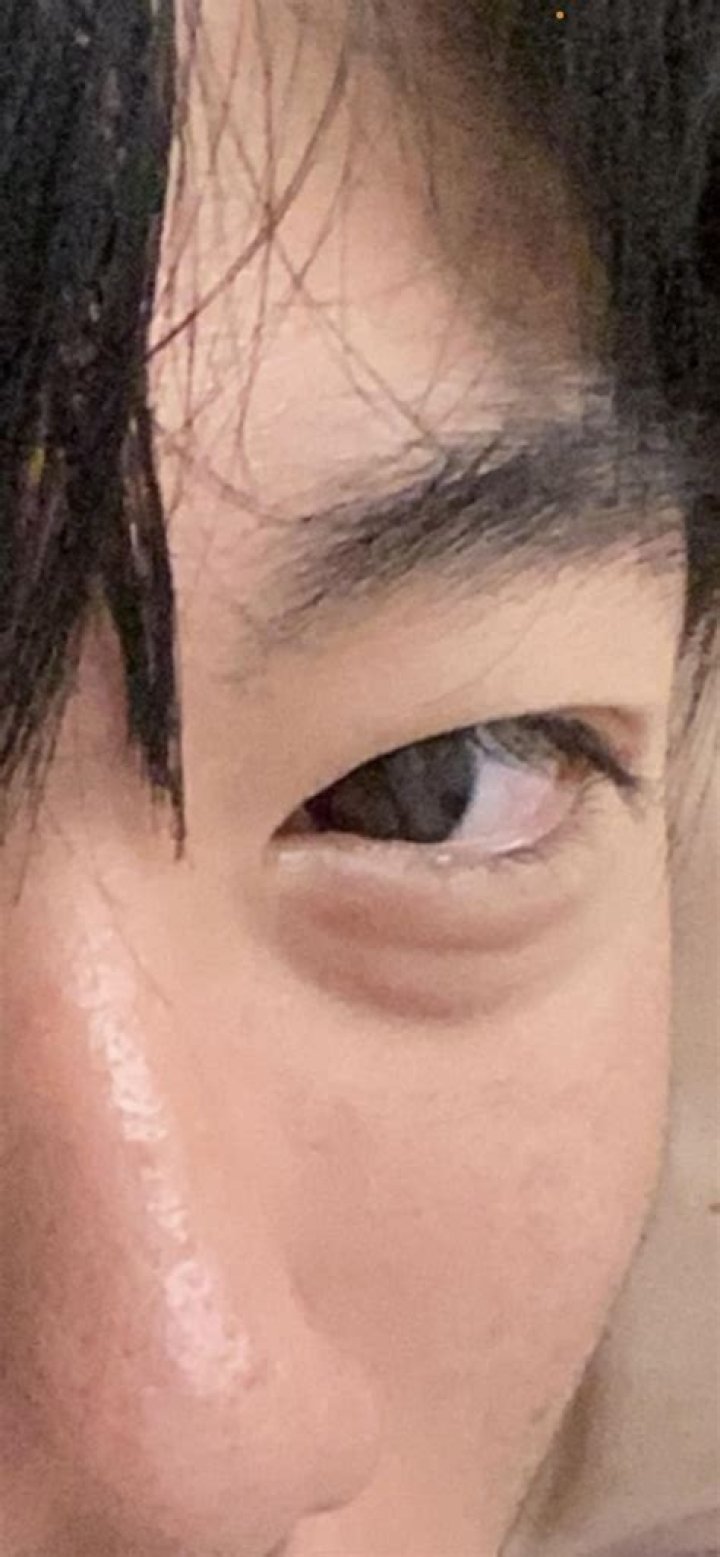 How can I get rid of my Eyebags?