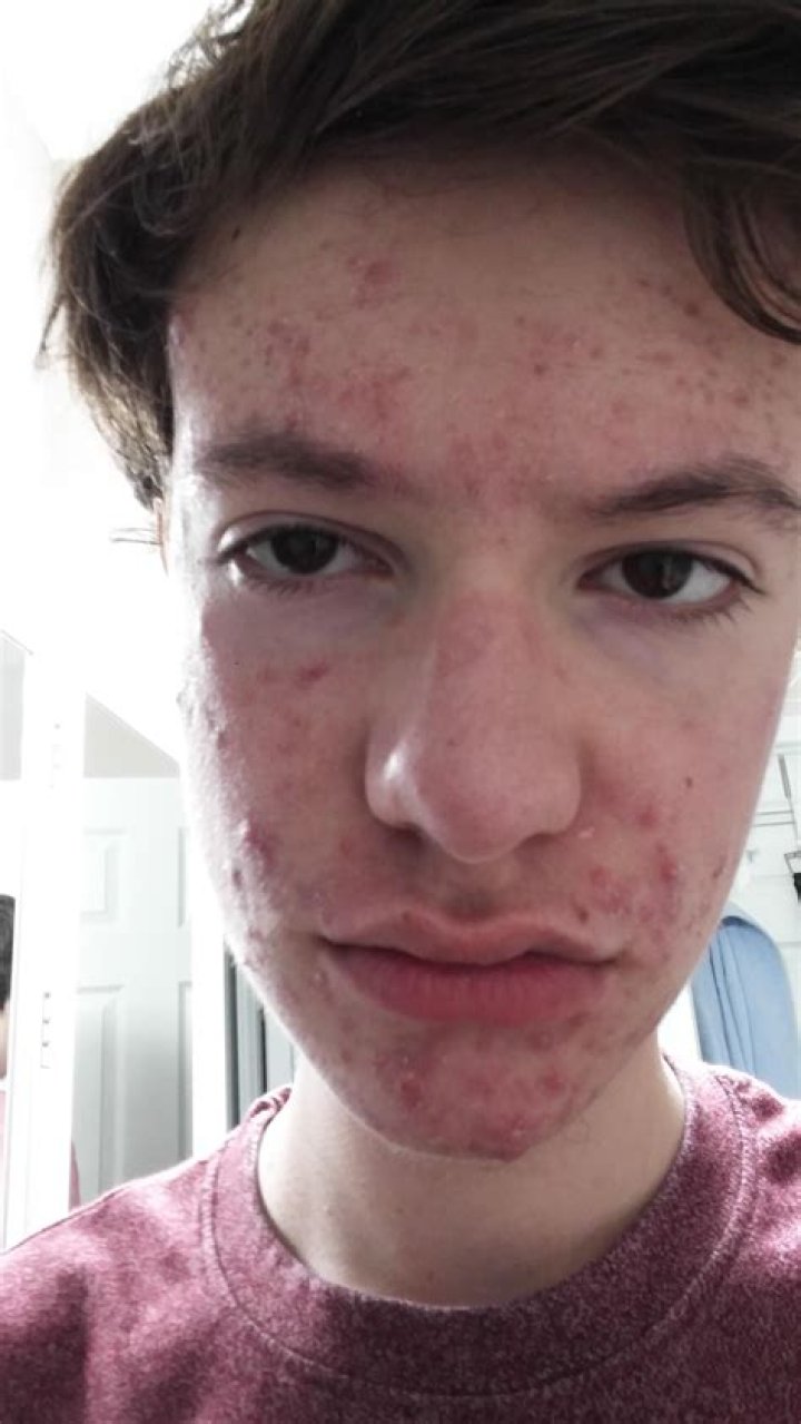 How can I help my 13 year old with acne?