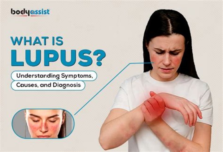 How did I get lupus?