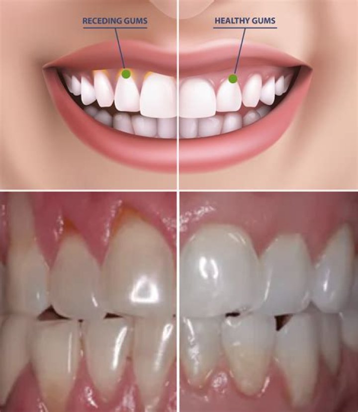 How do dentists fix receding gums?